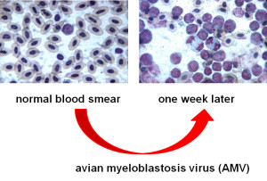 amv leukemia